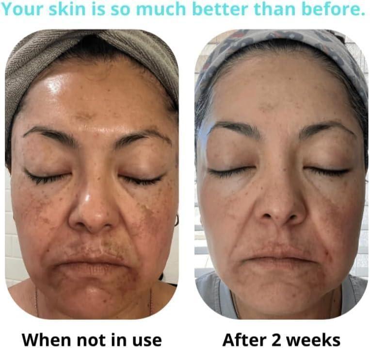 Saam renewal face cream, remove wrinkles, melasma, freckles, skin aging, dark skin